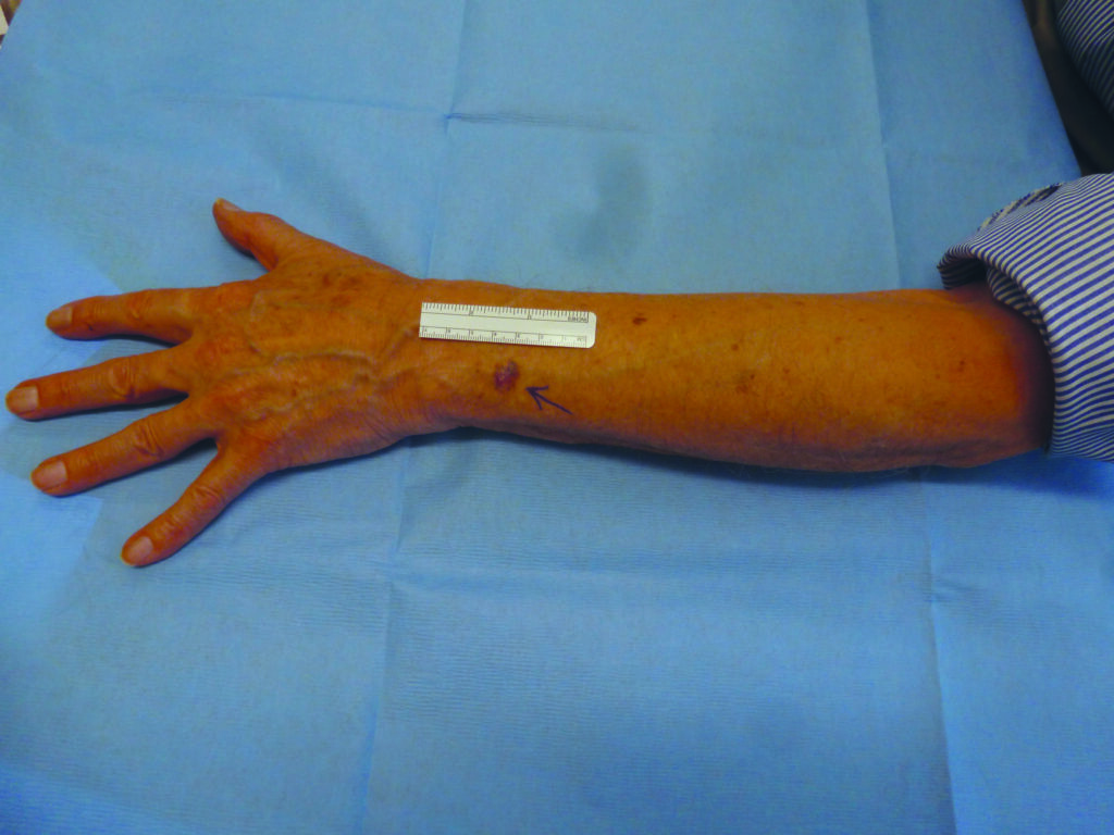 Overview photo of a lesion