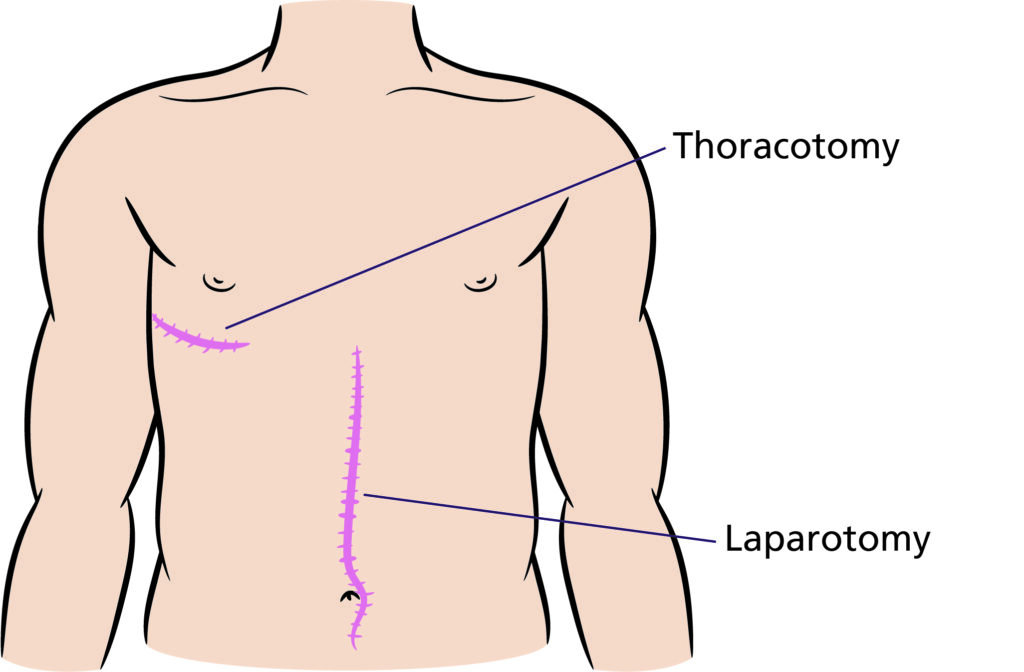 Figure B.
Illustration that shows wounds sites post Oesophagectomy (Thoracotomy right side of the chest and Laparotomy abdomen).