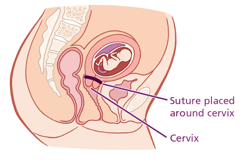 Diagram showing the placement of the shirodkar (high vaginal) cervical suture