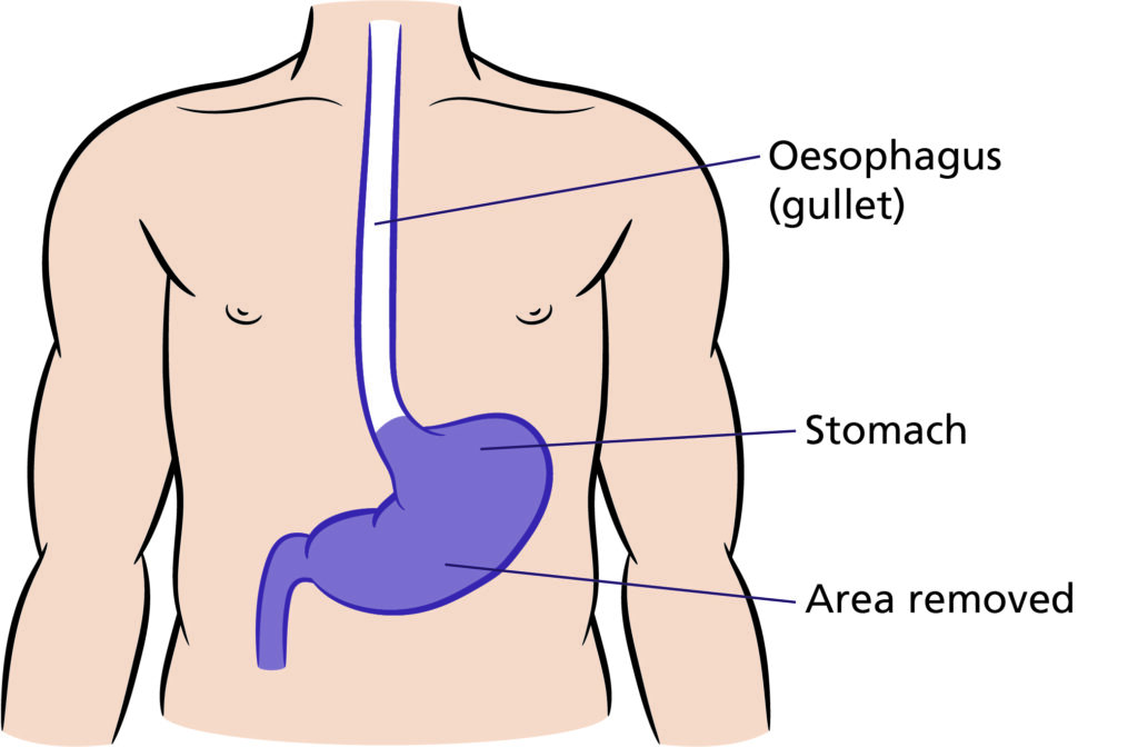 Illustration that shows the area to be removed for full gastrectomy which is the entire stomach (Shaded in purple).