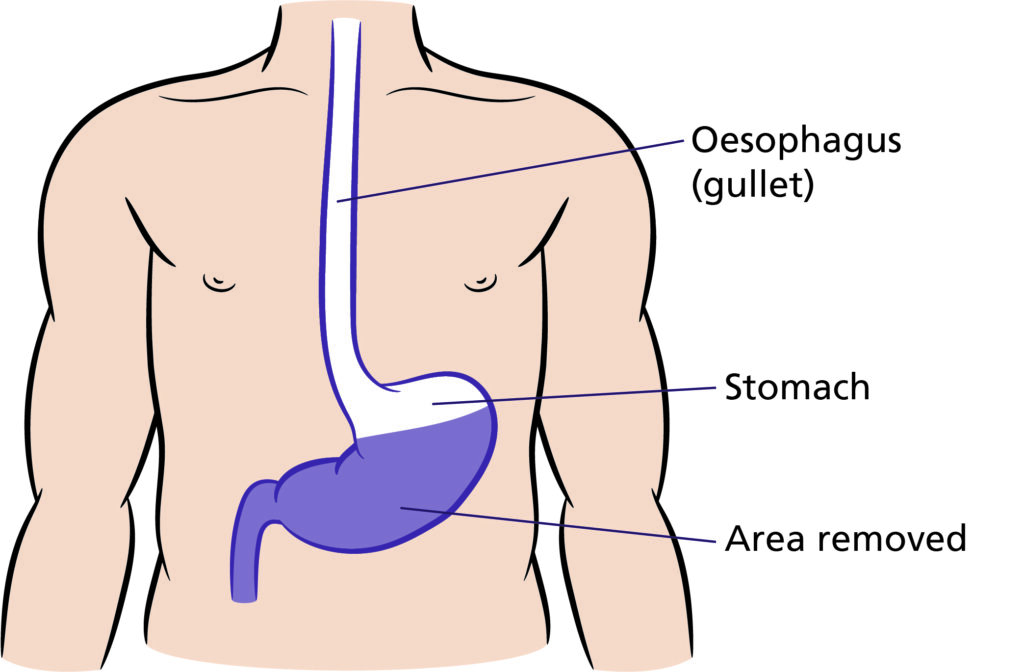 Figure B - Sub-total gastrectomy.
Illustration that shows the area removed for partial gastrectomy which is partial stomach (Shaded in purple)