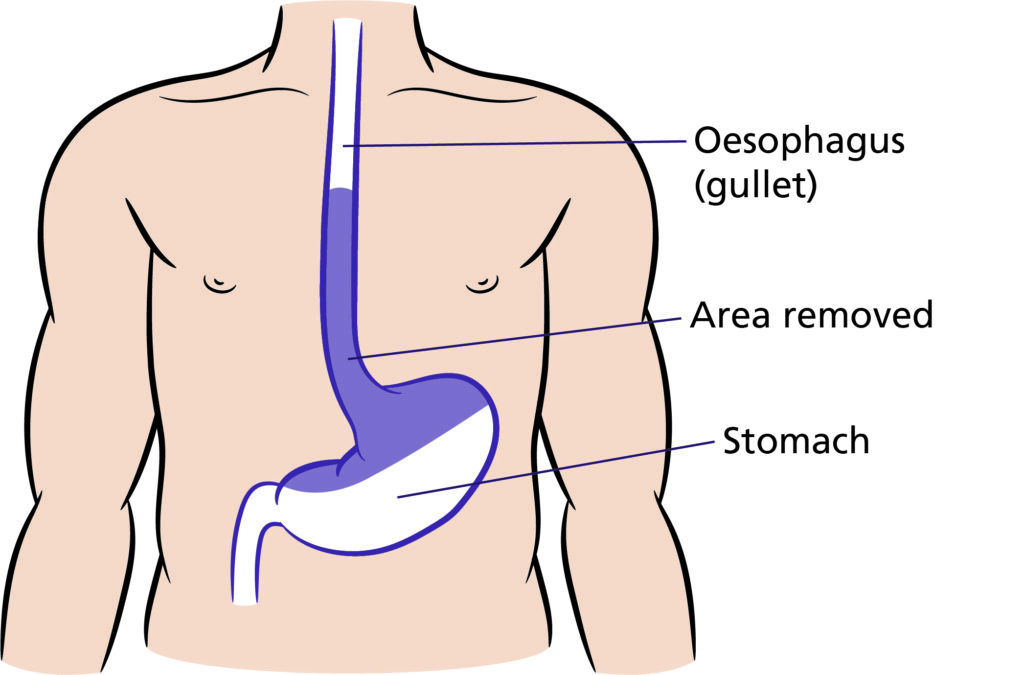 Figure A.
Illustration that shows the area to be removed during Oesophagectomy.