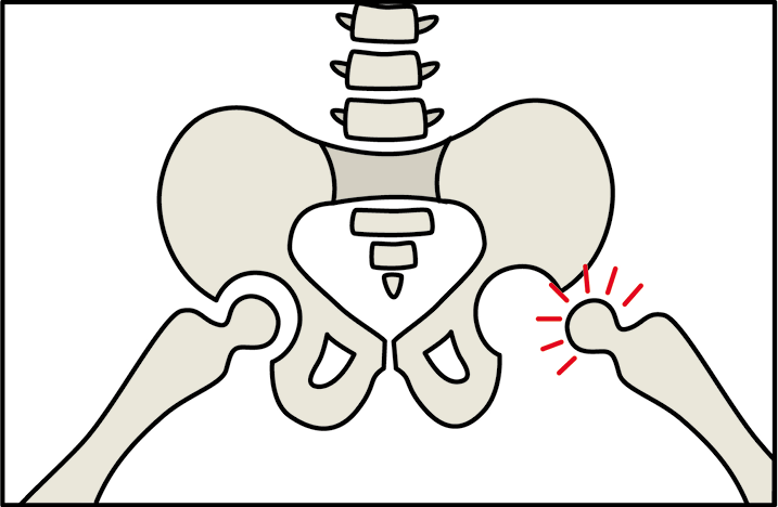 Subluxated Hip