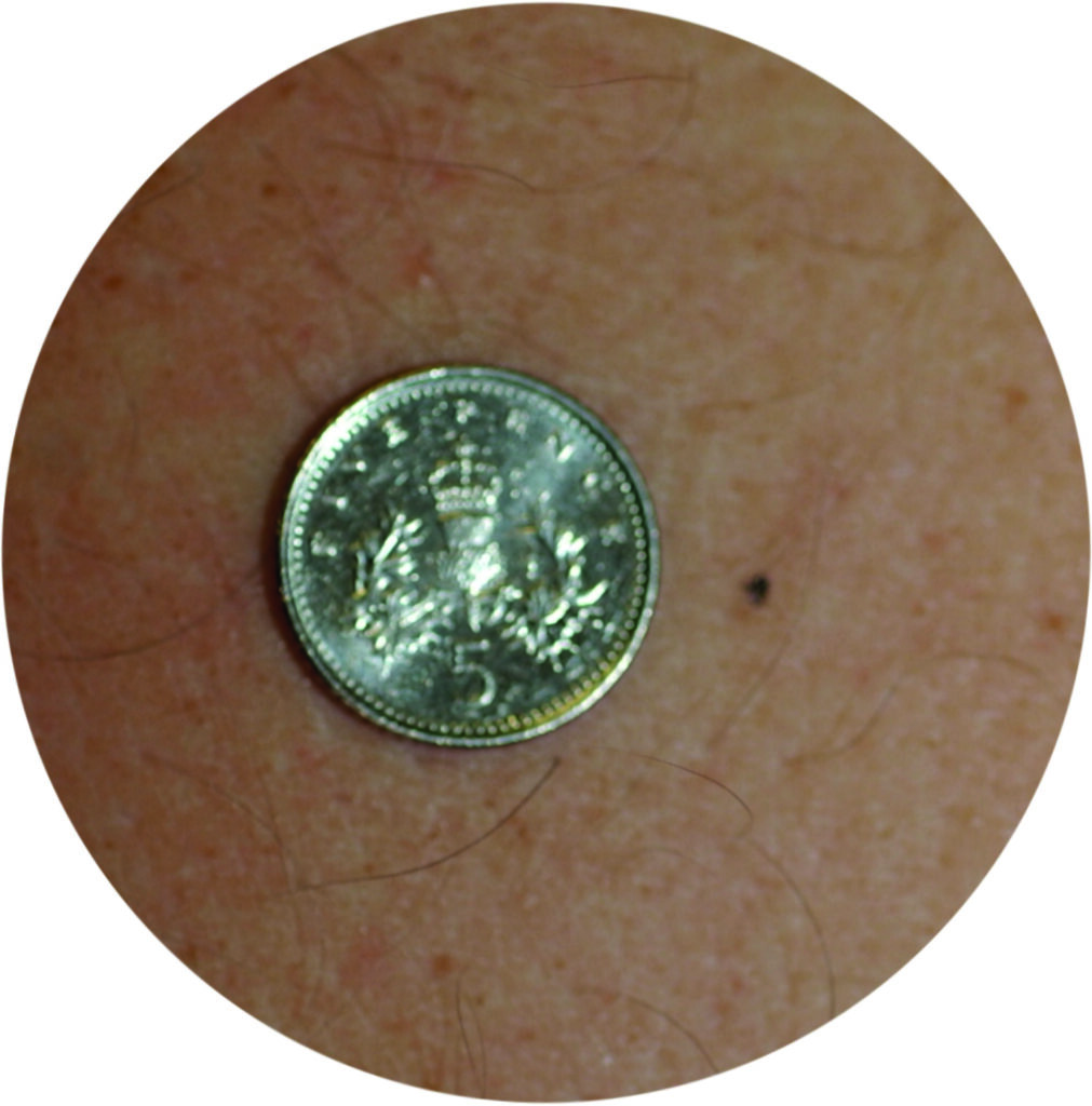Photograph of a permanent mark next to a five pence coin