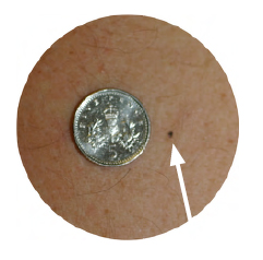 Photograph of a tattoo dot next to a five pence coin.
