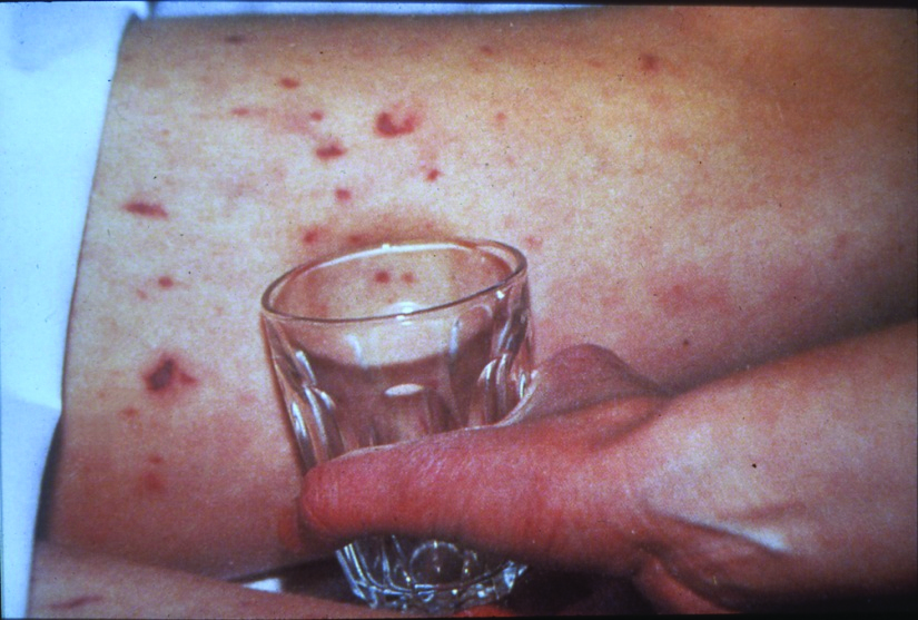 An image showing someone pressing a glass tumbler firmly against the rash.