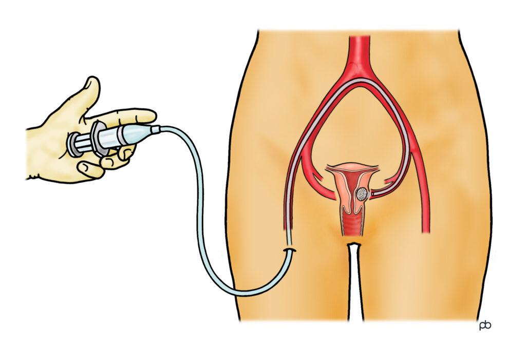 Illustration showing a small tube being fed into an artery (blood vessel) in the groin and then passed to the artery to the womb. Plastic particles are then injected to block the blood supply to the fibroid.