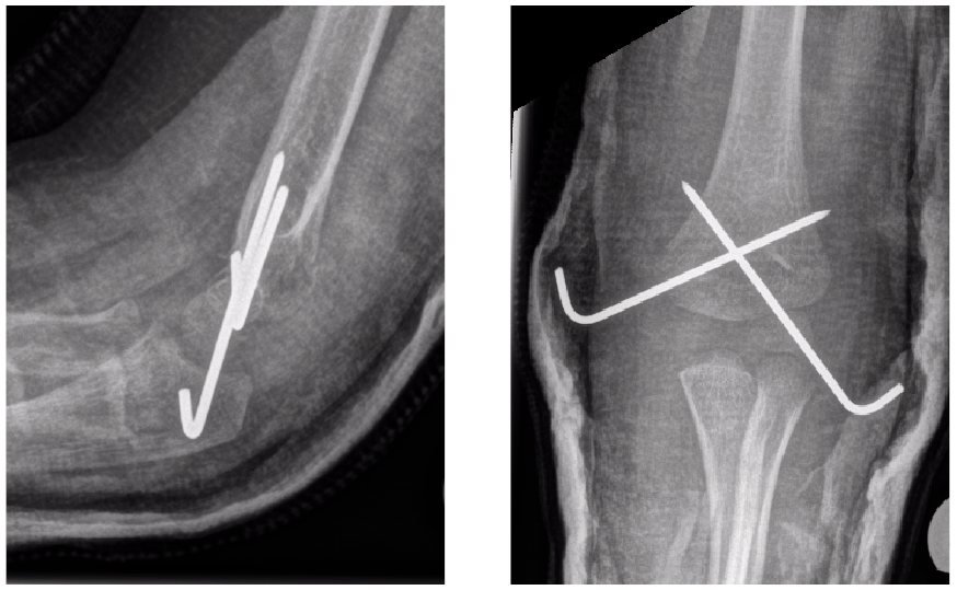 Images of x-rays showing the wires in the body.