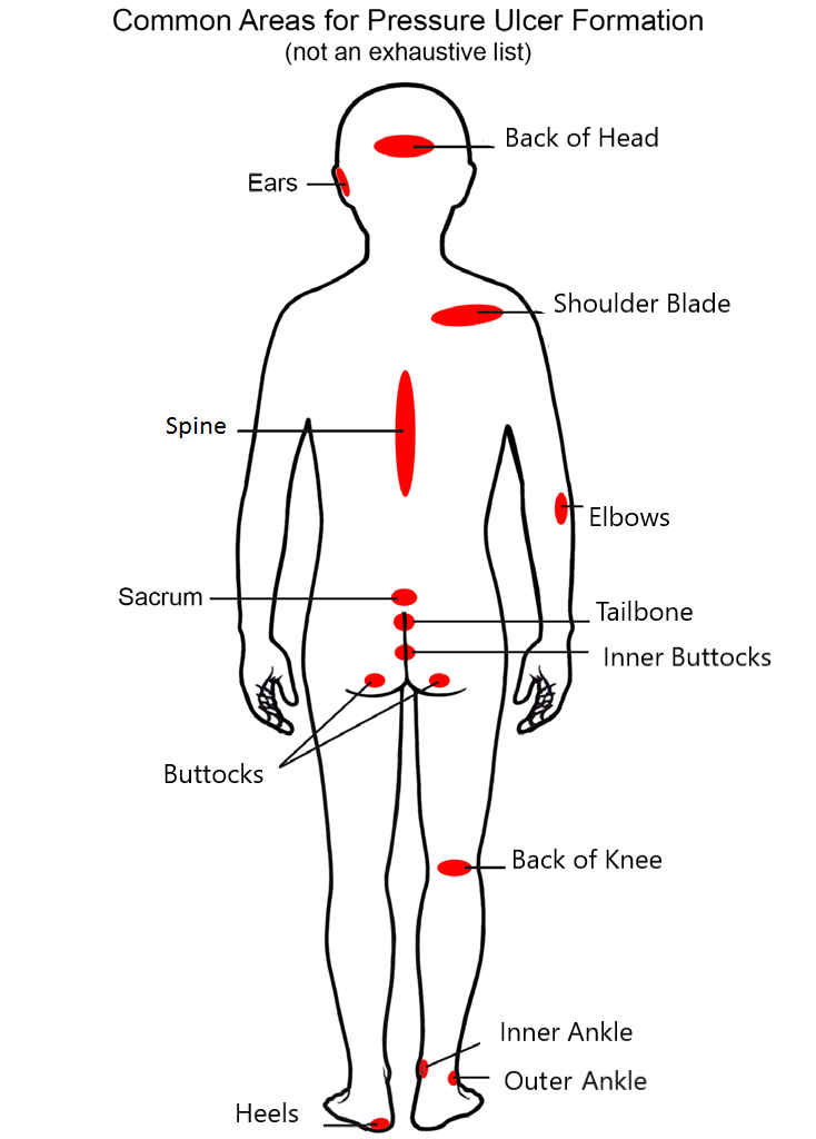 Image showing areas highlighted in red where pressure ulcers may develop and the risk areas when sat in a chair/wheelchair or laid down.