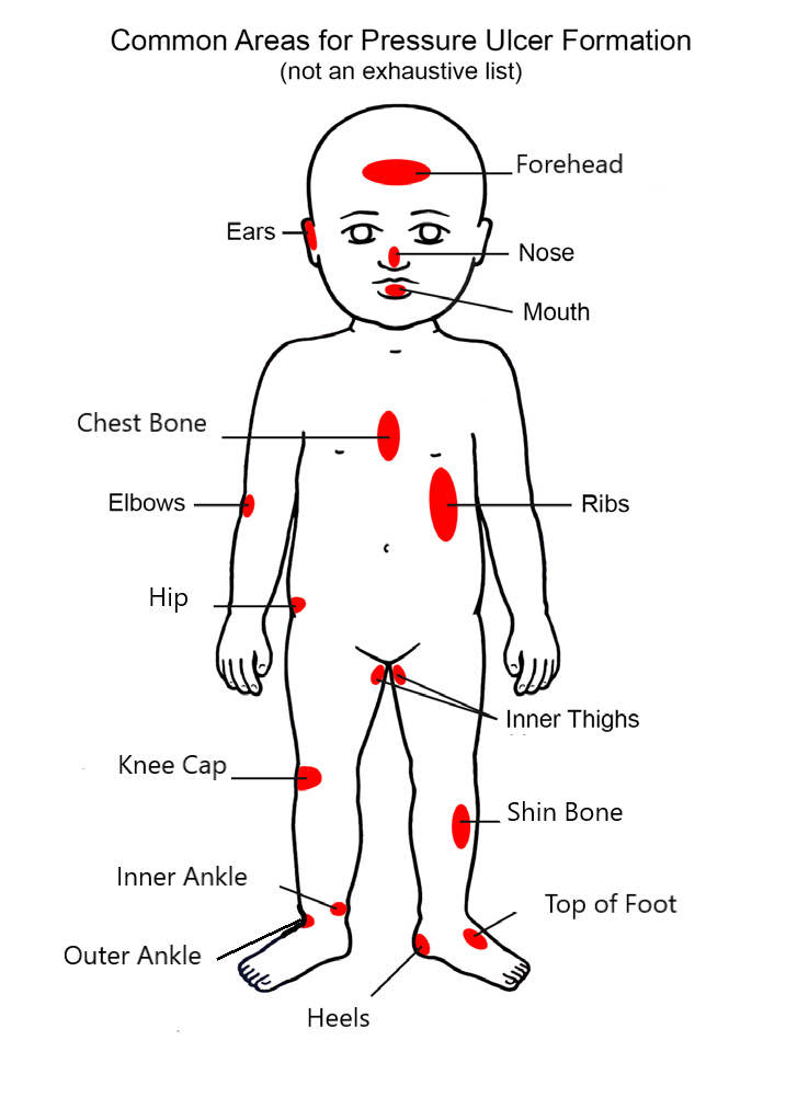 Image showing areas highlighted in red where pressure ulcers may develop and the risk areas when sat in a chair/wheelchair or laid down.