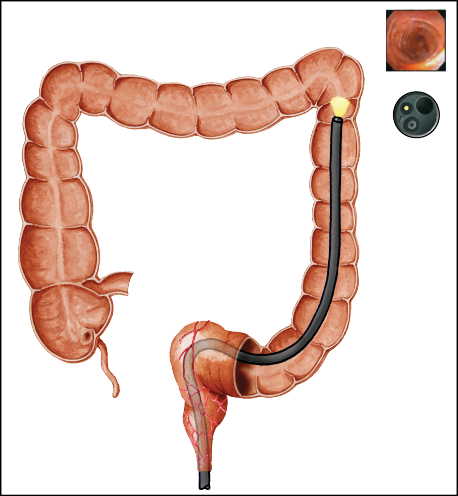 Illustration showing the colonoscopy procedure on the large bowel.