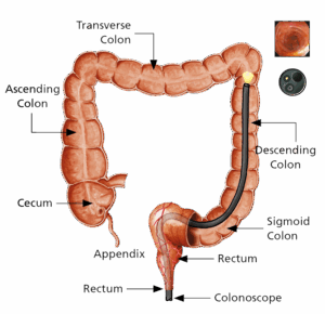 Having a Colonoscopy - A guide to the test - Leeds Teaching Hospitals ...