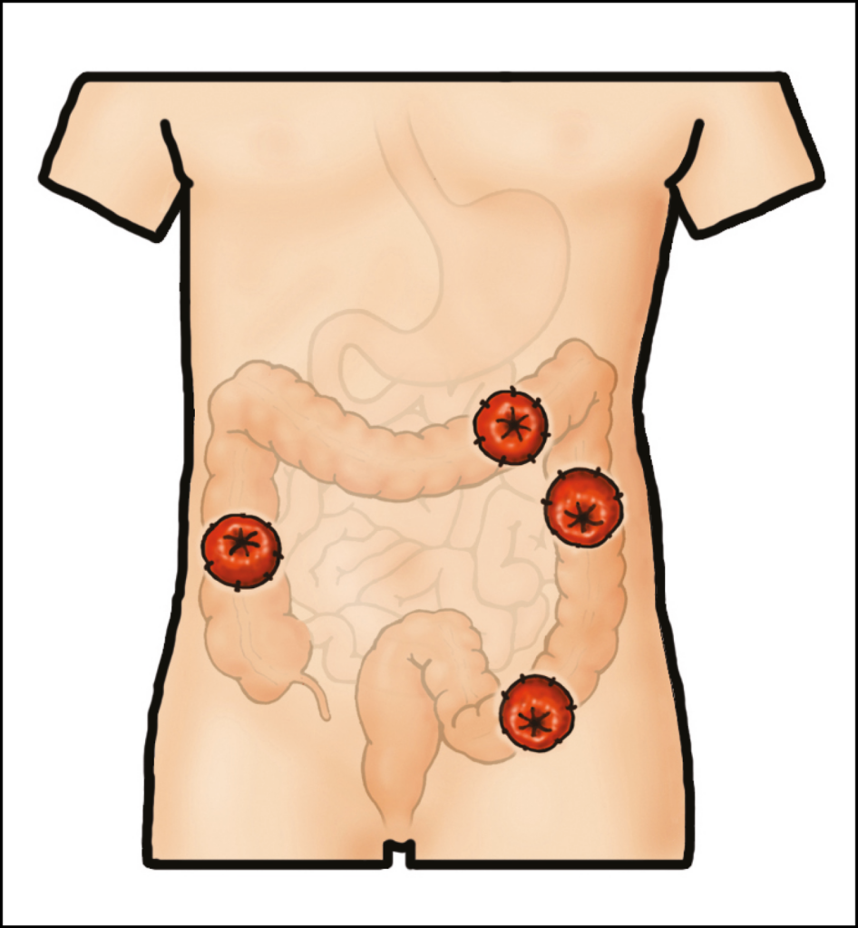 Illustration showing colonoscope insertion via patient stoma site.