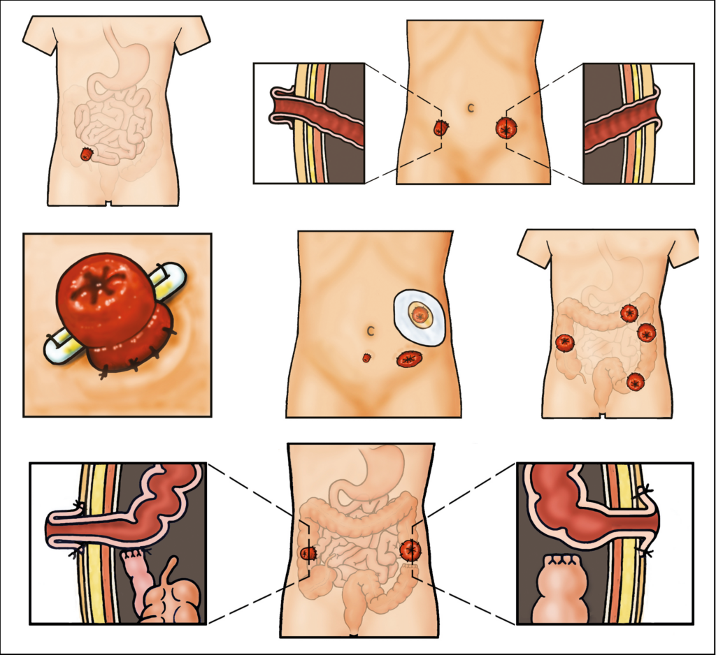 Multiple Illustrations showing alternate colonoscope insertion sites via a patient ileostomy.