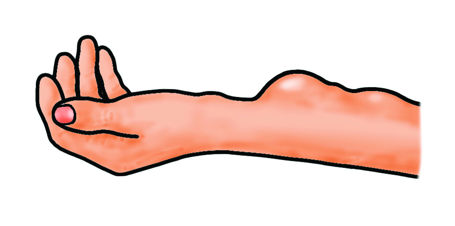Illustration showing dilated fistula vessels or aneurysmal vessels.