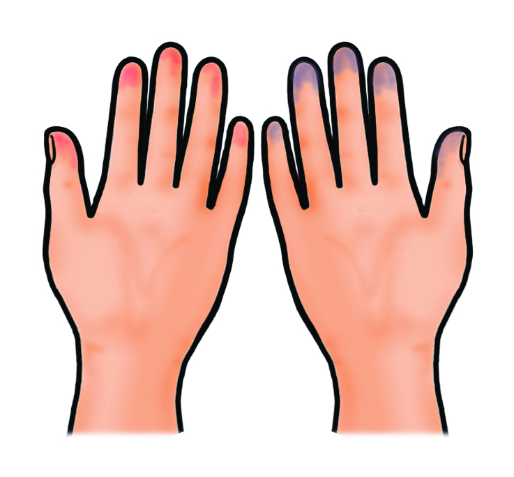 Illustration showing a persons that show the presence of potential steal syndrome.