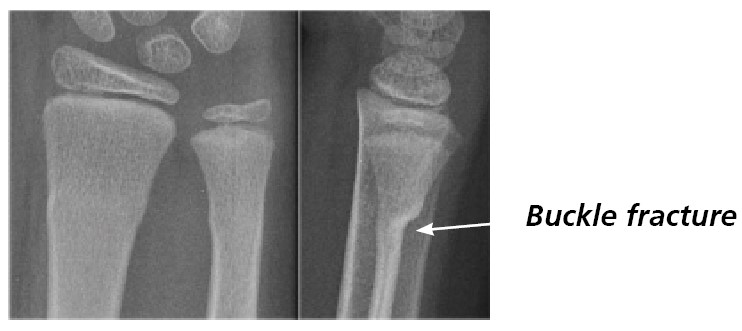 X-ray of a bone showing a buckle fracture