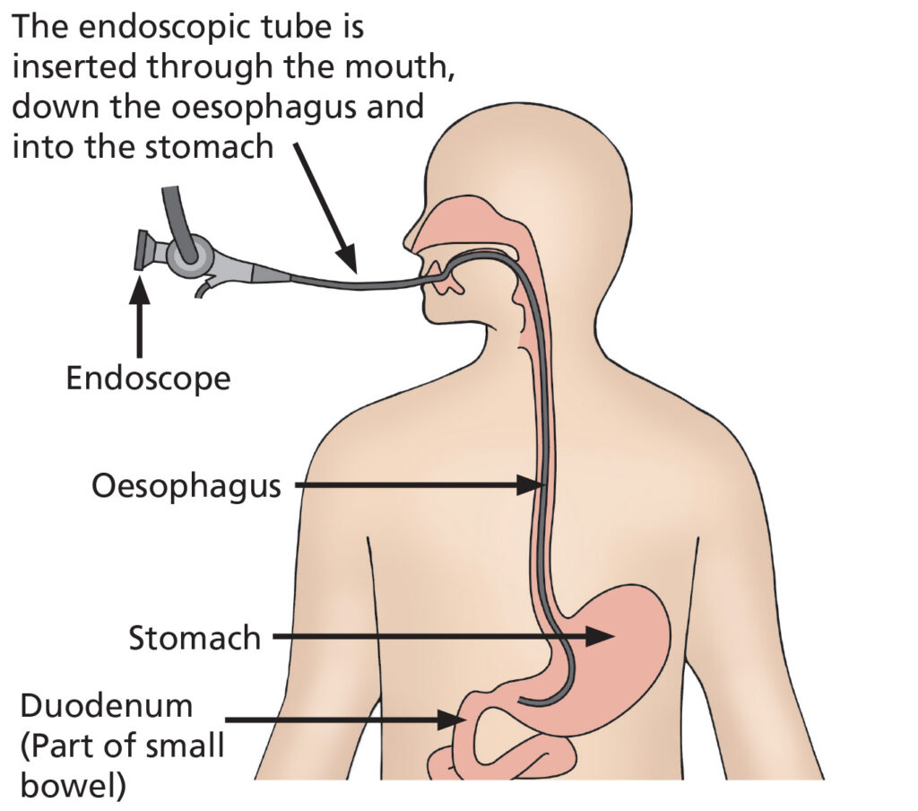 Illustration of a Gastroscopy, showng the endoscopic tube beng inserted through the mouth, down the oesophagus and into the stomach.
A Gastroscopy is a safe, minimally invasive procedure. A Endoscopist passes a thin flexible tube with a camera used to examine the lining of the throat, Oesophagus, stomach and small intestine (duodenum).