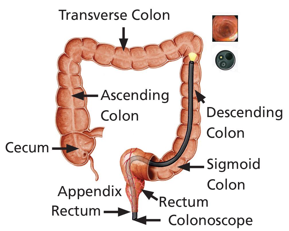 An illustration of a Sigmoidoscopy. A thin flexible tube with a camera on the end is used to examine the lower third of your bowel. Passing from the rectum, sigmoid colon and then descending colon only.