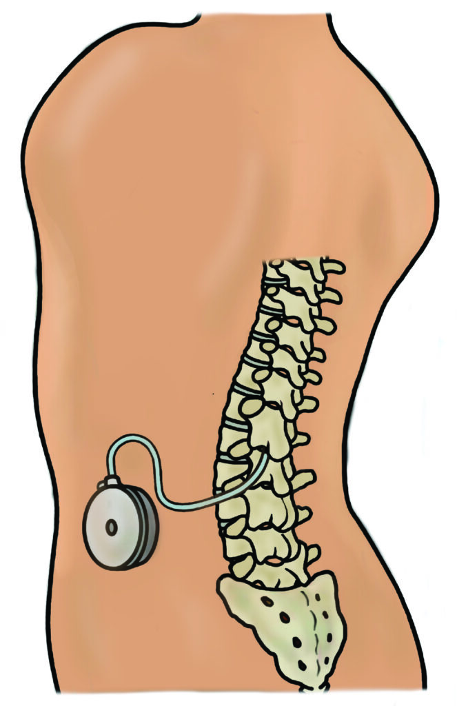 Figure 2 - Illustration of intrathecal baclofen pump attached to the spine.