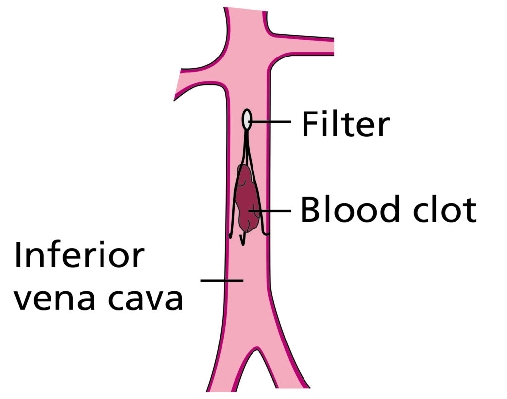 Diagram showing an inferior vena cava (IVC) filter, with a blood clot trapped inside the filter within the IVC to prevent the clot travelling through the bloodstream.