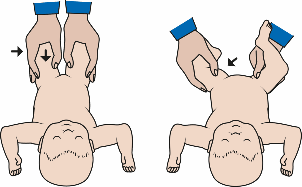 Illustration showing a stability test of an infants hip joints.