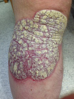 Close up photo of a rash