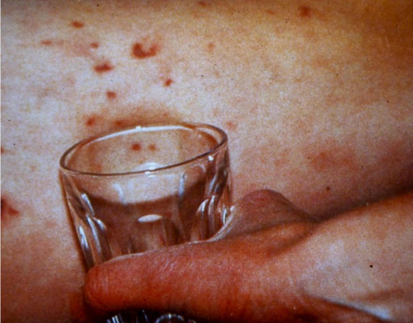 Photograph of a clear glass being pressed against a persons skin to see if the rash disappears.
