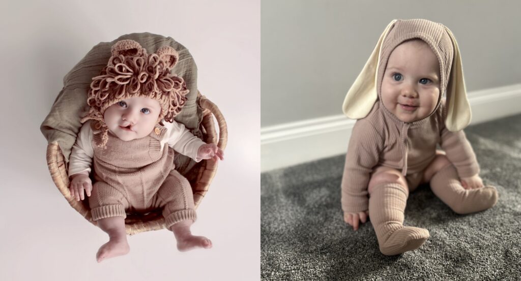 A collage of 2 images showing baby Theo before on the left hand side and on the right hand side showing after having treatment.