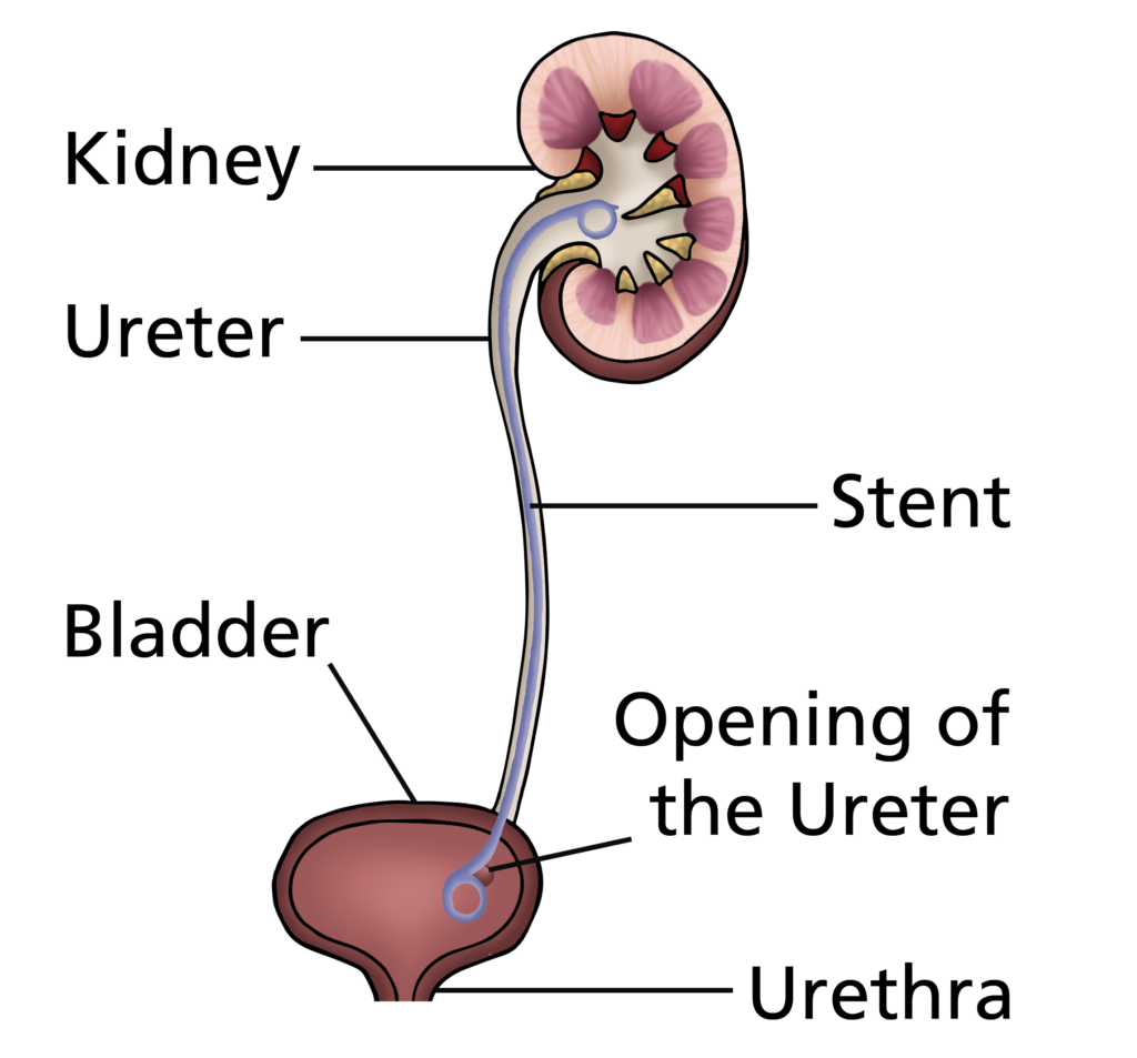 An image showing a stent in position in the ureter