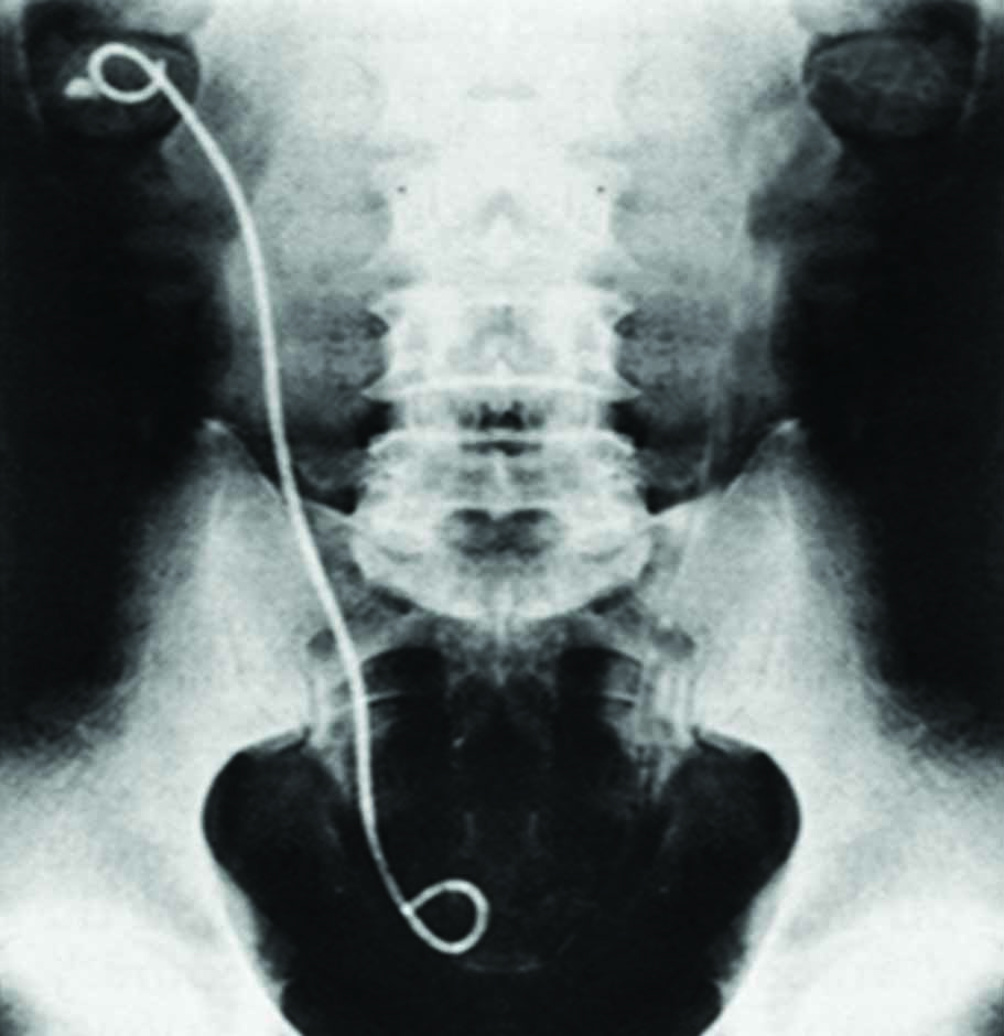 An x-ray image of a stent in position