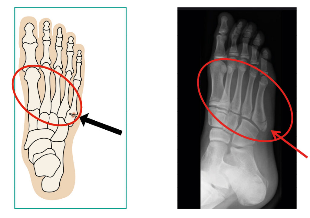 Illustration and photograph of a fracture to the middle part of the foot