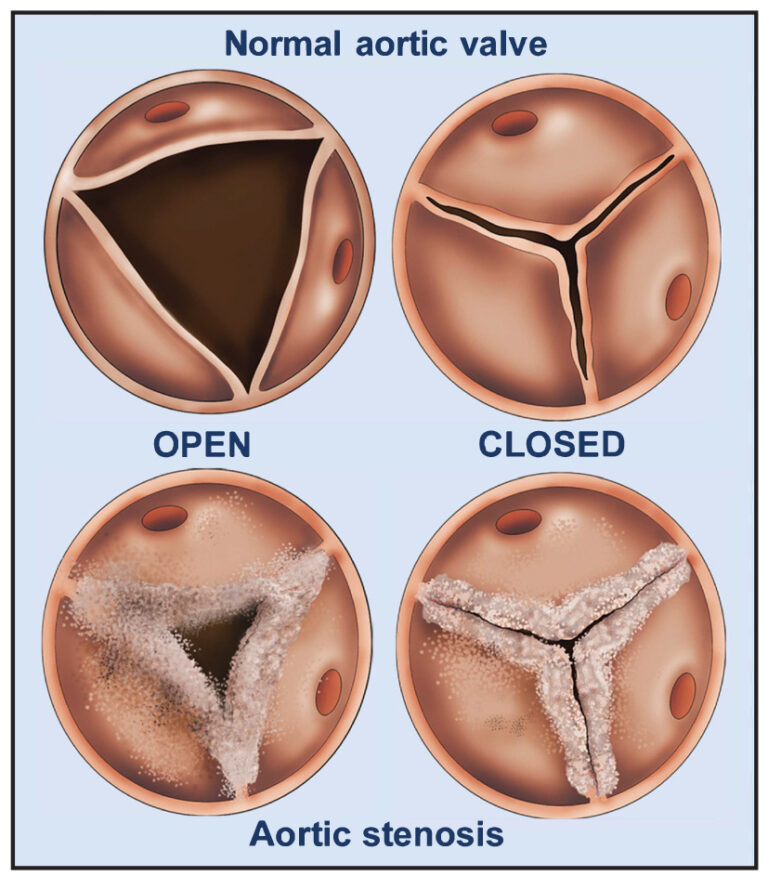 Aortic Stenosis Leeds Teaching Hospitals NHS Trust Aortic Stenosis Leeds Teaching Hospitals NHS Trust