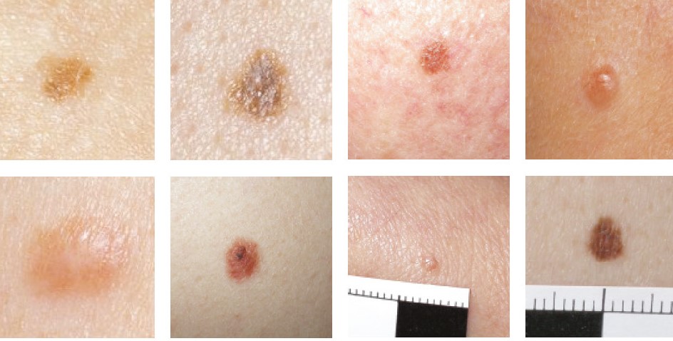 Looking After Your Moles Leeds Teaching Hospitals NHS Trust