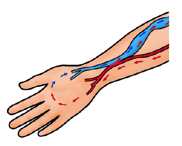 Illustration showing a fistula, a joining of a vein and artery.
