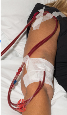 Photograph of a graft in the arm.