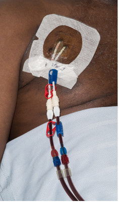 Photograph of a dialysis line inserted through the chest.