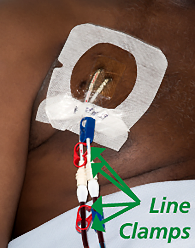Photograph of a dialysis line inserted through the chest highlighting the clamps.