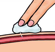 Illustration showing the application of pressure to bleeding point and showing the layers of skin.