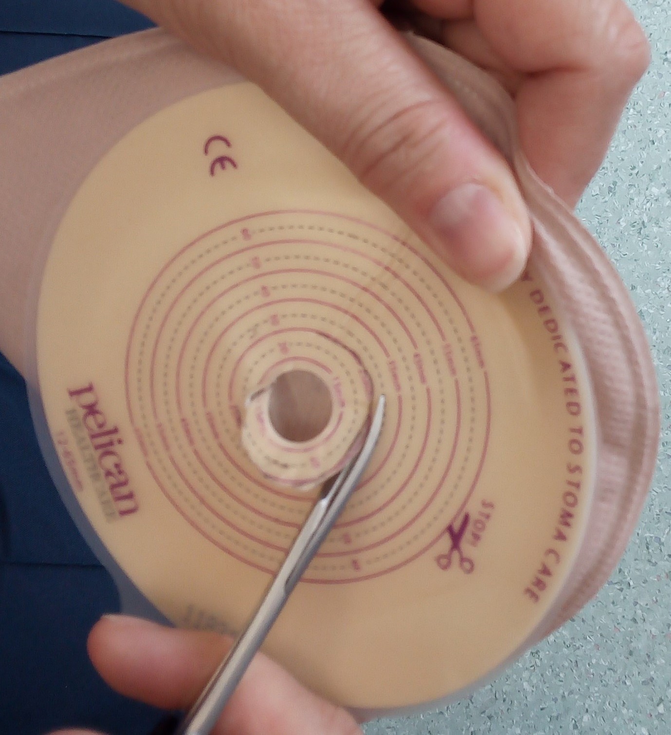 Paediatric step by step procedure for a 1 piece stoma bag change ...