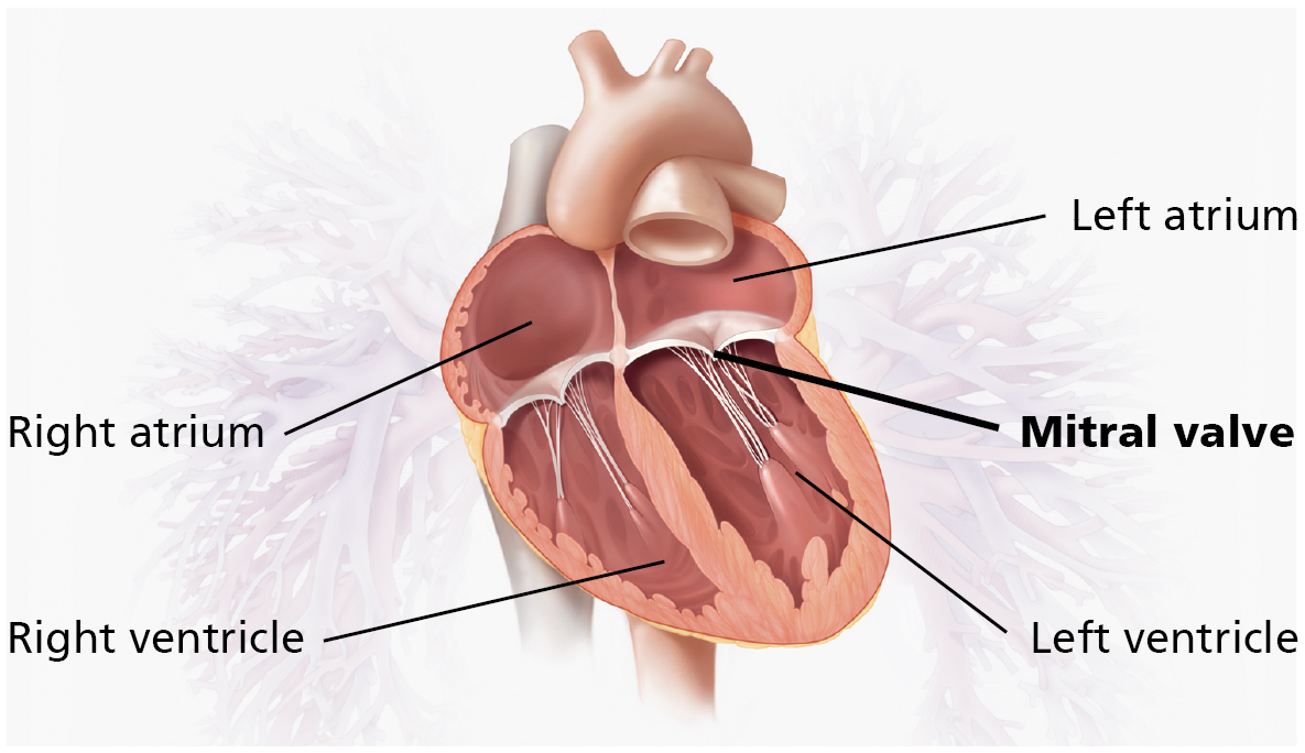 Mitral Valve Transcatheter Edge to Edge Repair TEER Leeds Teaching 