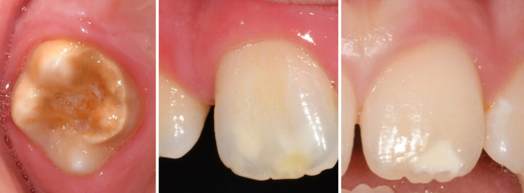Molar incisor Hypomineralisation MIH Leeds Teaching Hospitals NHS Trust