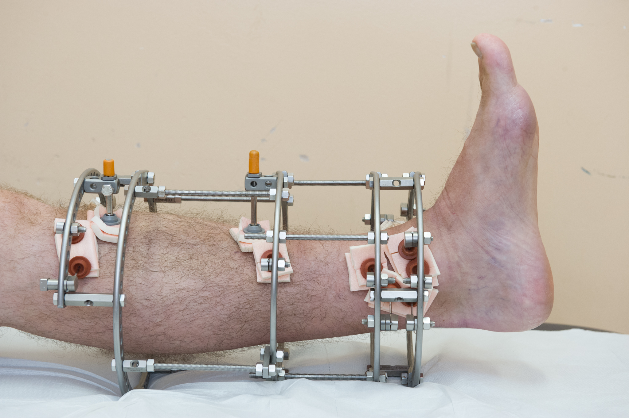 Having an External Fixation Device - Adults - Leeds Teaching Hospitals ...