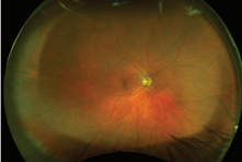 An ultra widefield image of the retina.