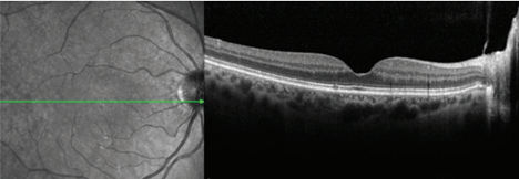 An image showing an OCT scan of the retina.