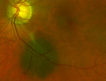 An image showing a naevus.