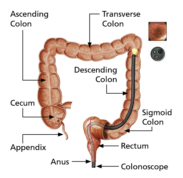 Anatomical illustration of the colon showing a colonoscope entering the anus, going up the rectum into the sigmoid colon.