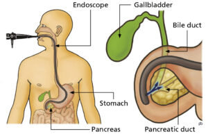 Having an ERCP - Leeds Teaching Hospitals NHS Trust