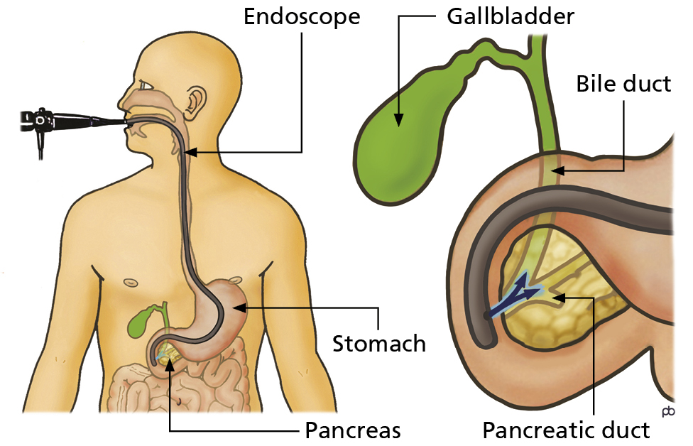 Illustration of the ERCP test showing the endoscope going down the oesophagus into the stomach then into the small intestine.
