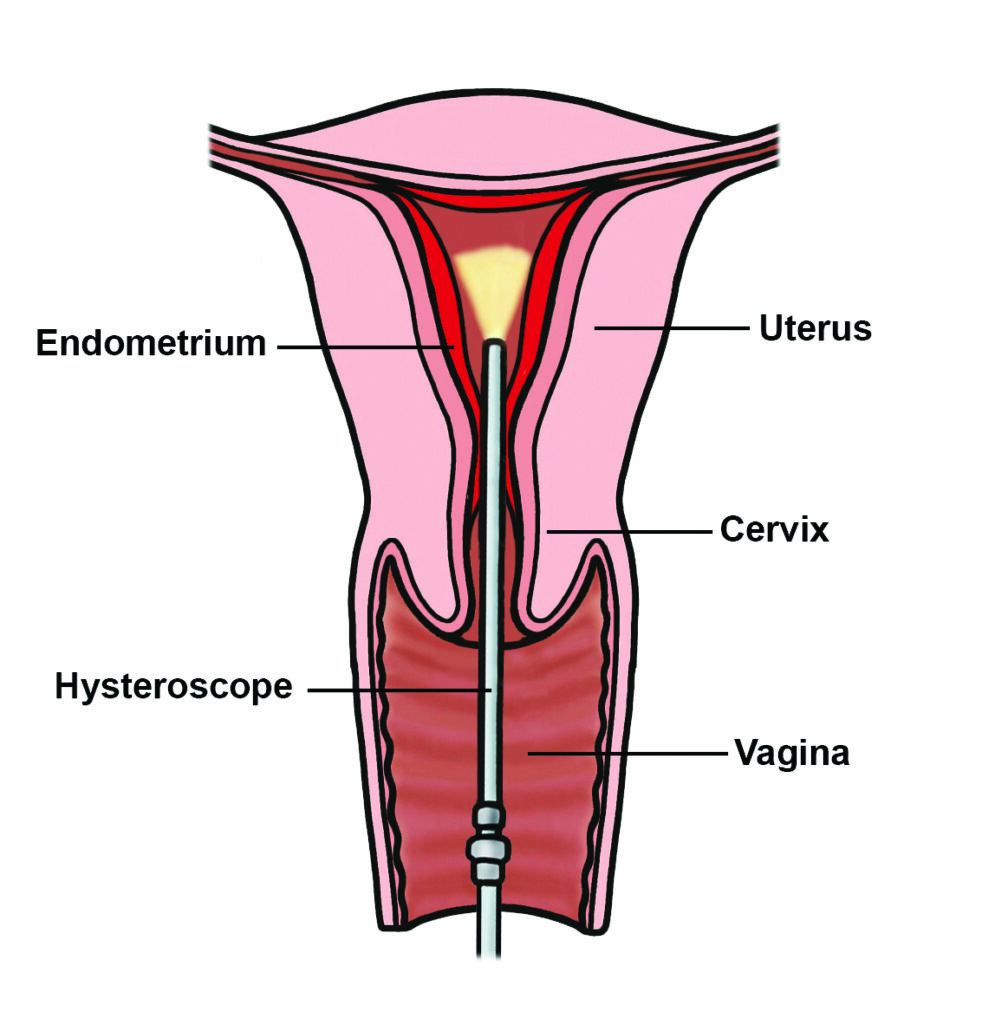 Illustration of a hysteroscope camera passing through the vagina and cervix to allow inspection inside the cavity of the womb.